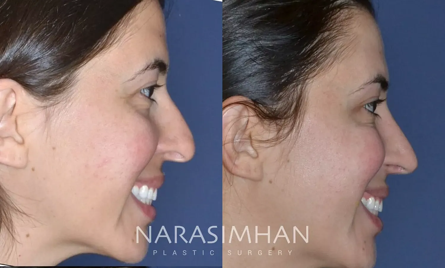 Facial Sculpting Before & After