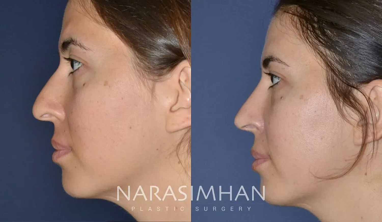 Facial Sculpting Before & After