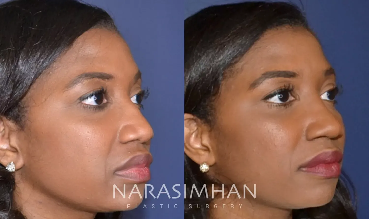 Facial Sculpting Before & After