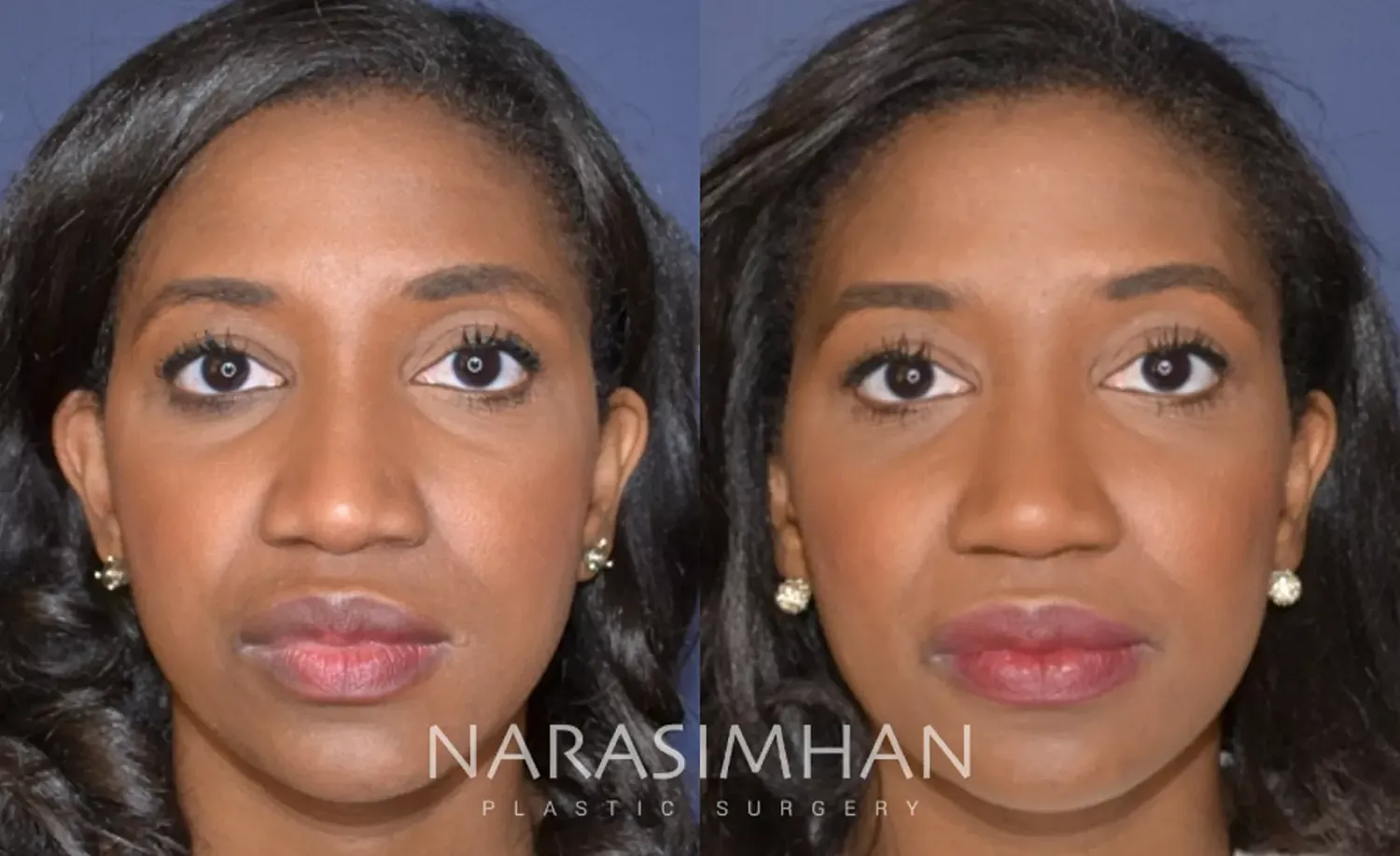 Facial Sculpting Before & After