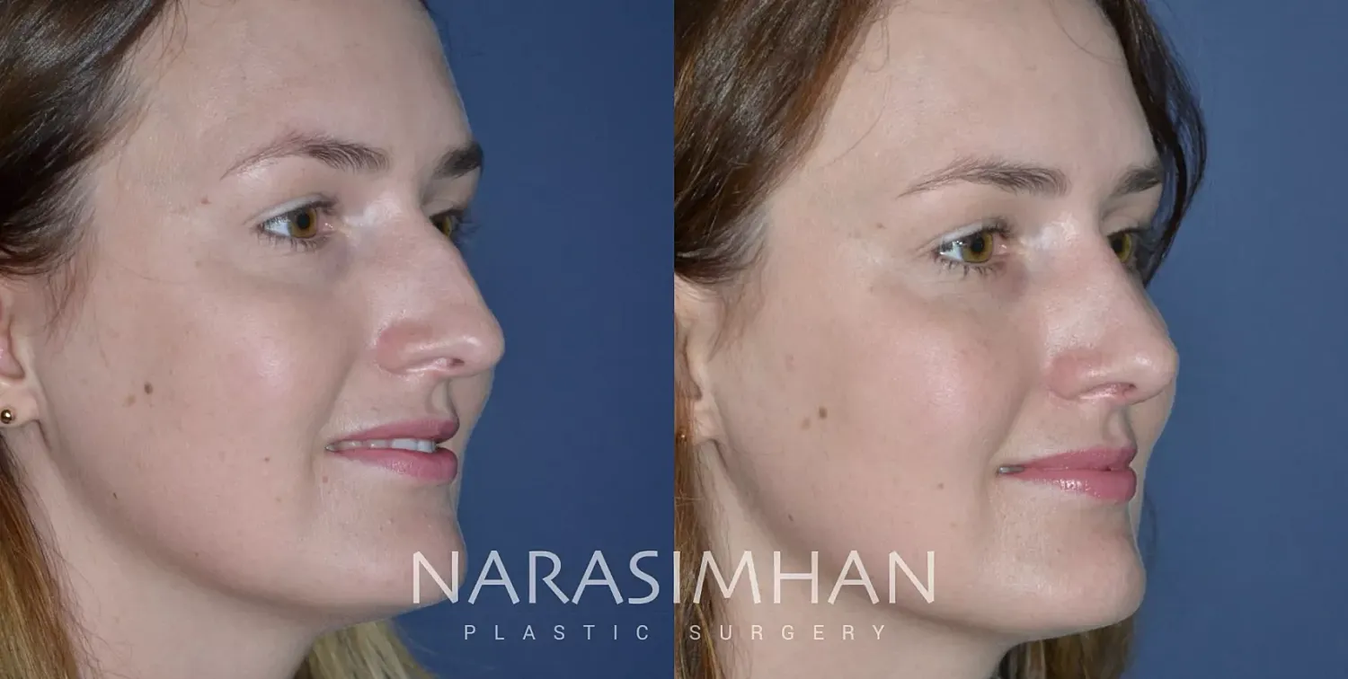 Facial Sculpting Before & After