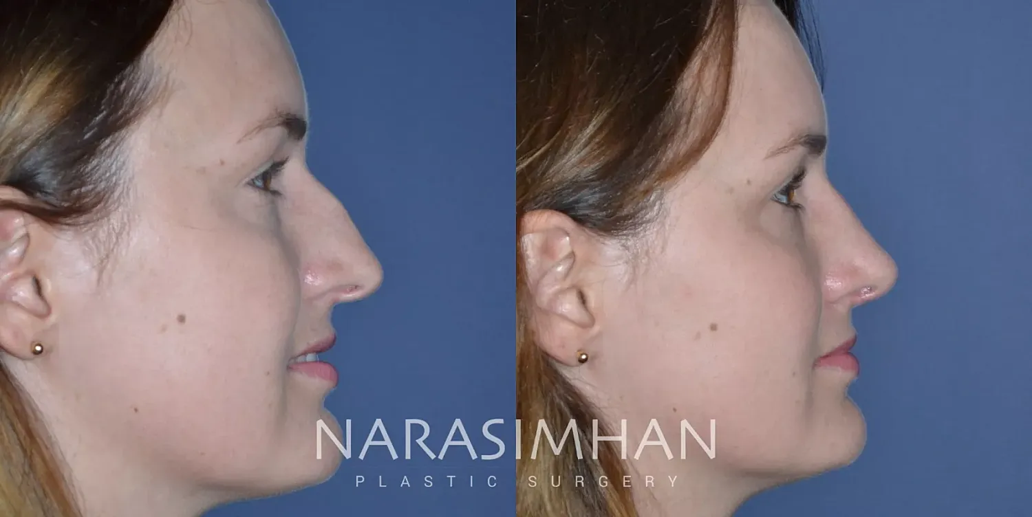 Facial Sculpting Before & After
