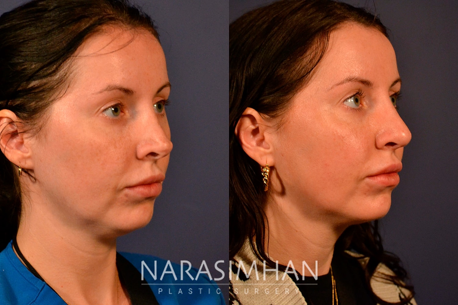 Facial Sculpting Before & After