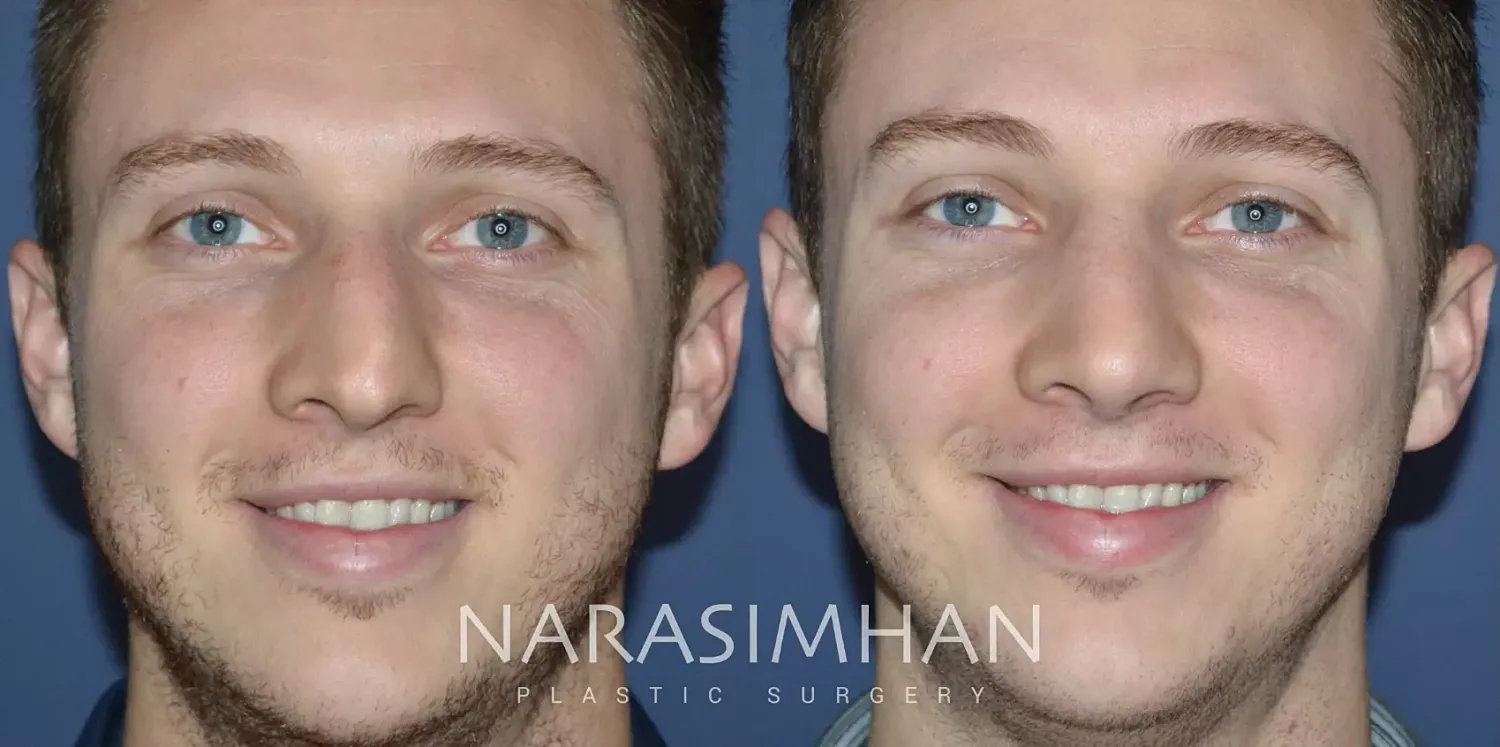 Facial Sculpting Before & After