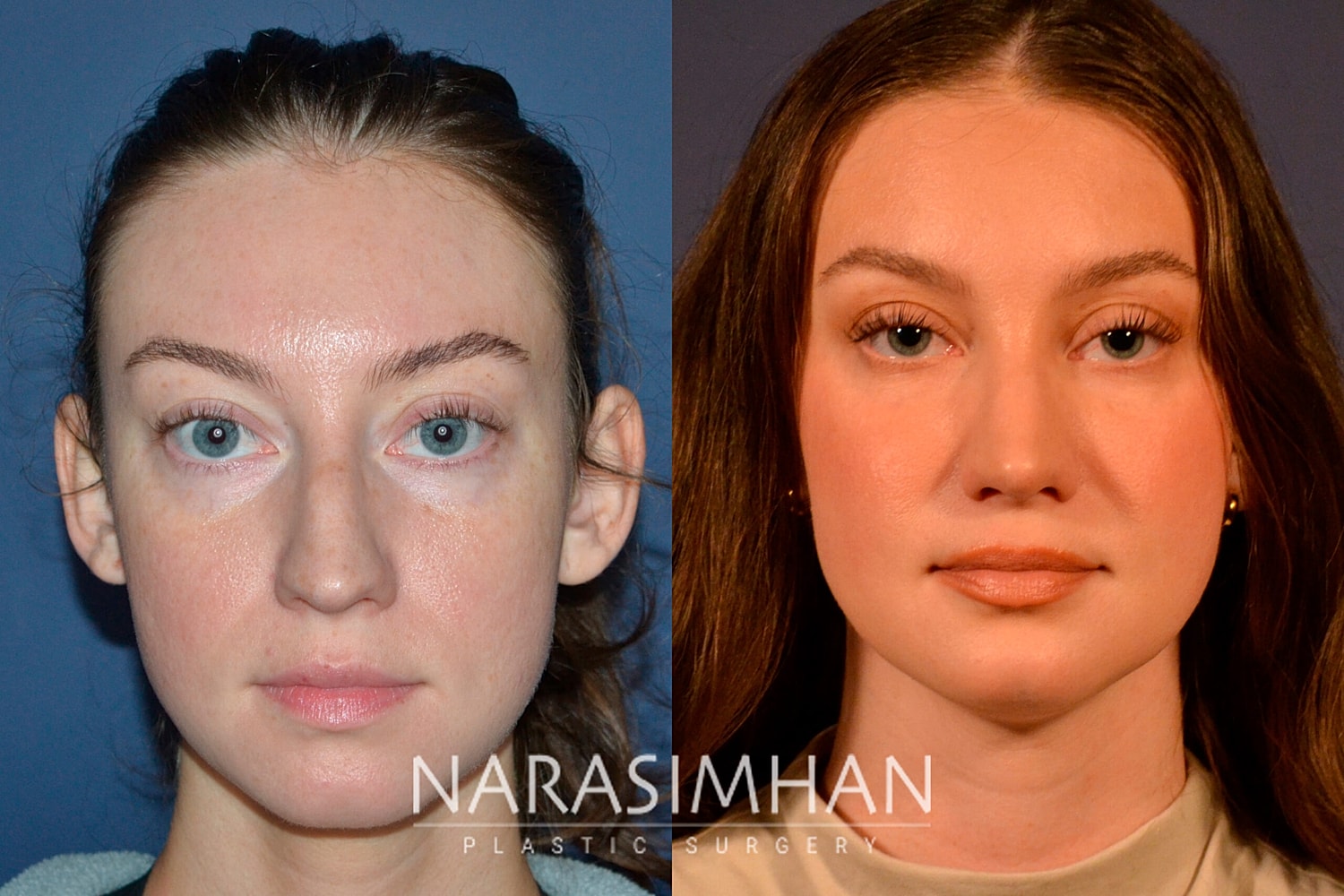 Facial Sculpting Before & After