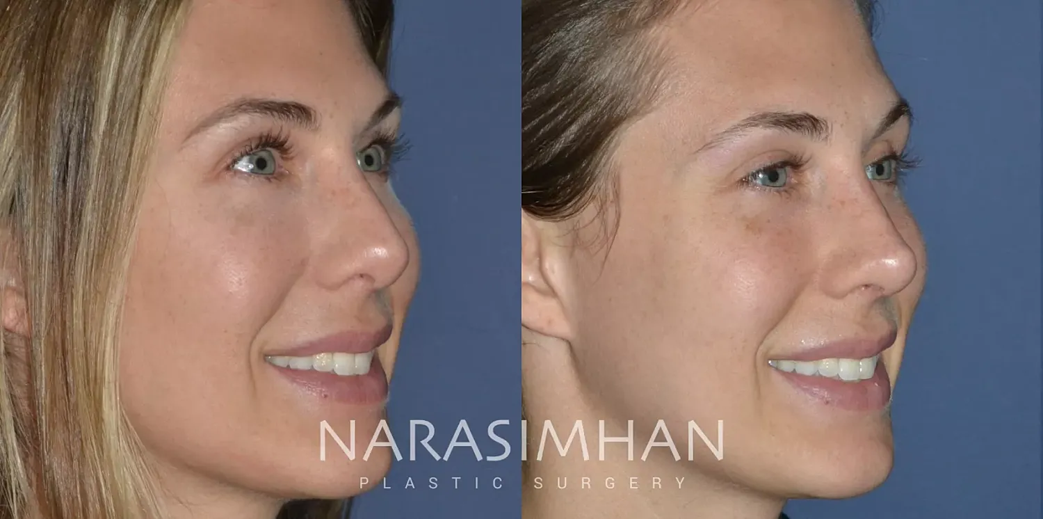 Facial Sculpting Before & After