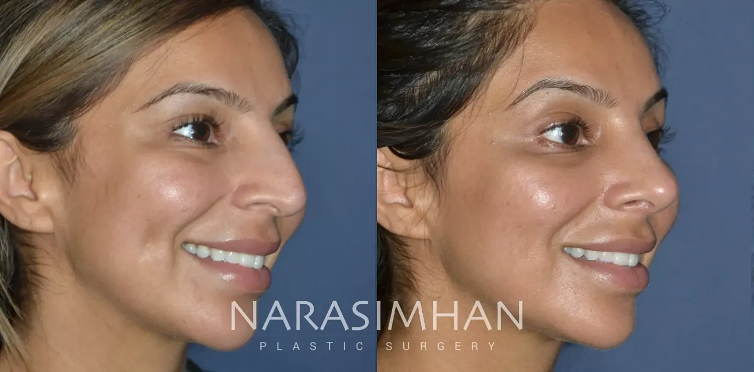 Facial Sculpting Before & After
