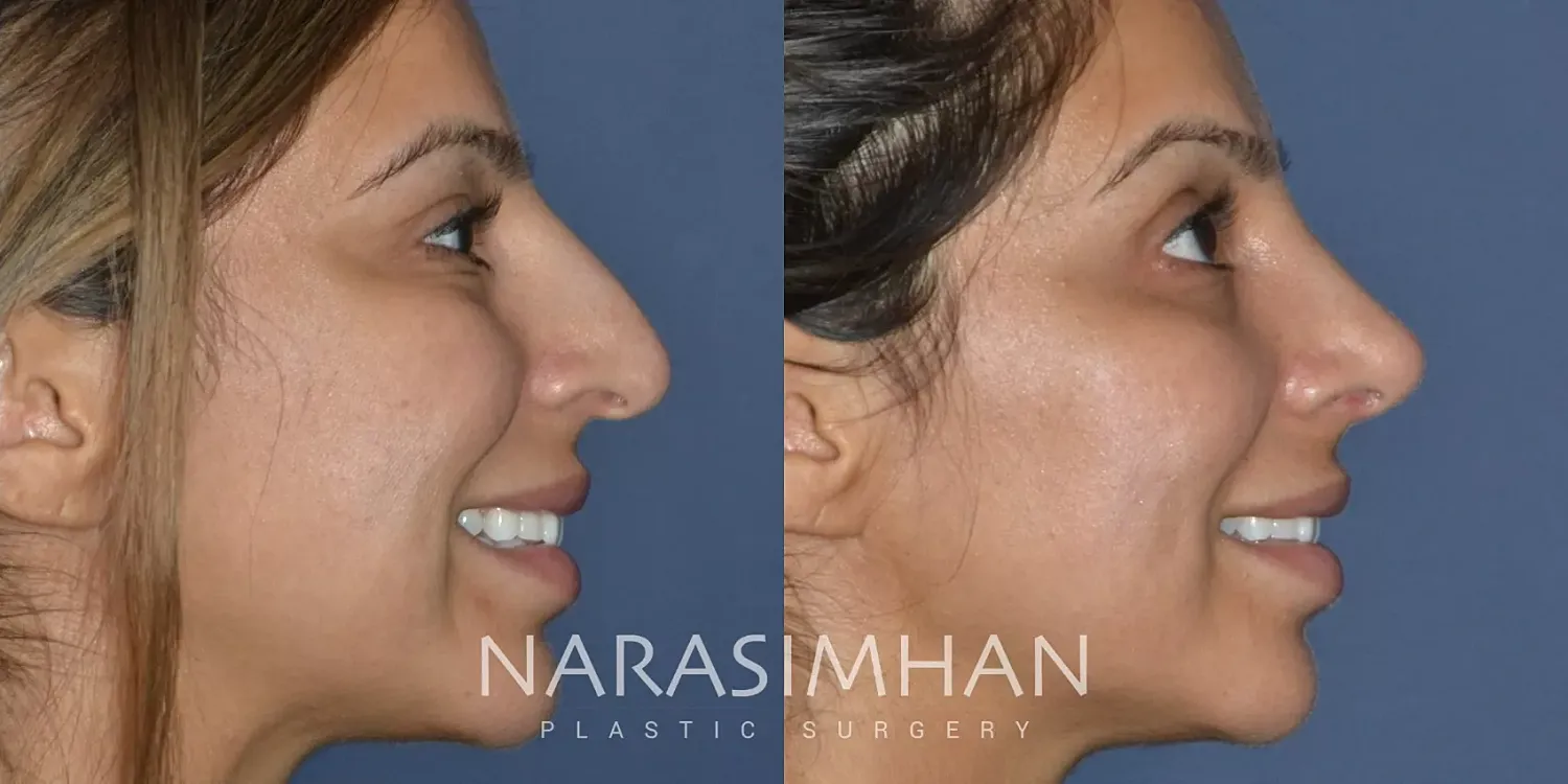 Facial Sculpting Before & After
