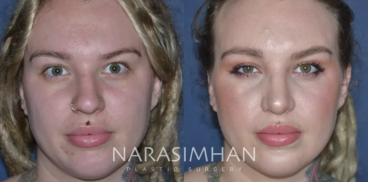 Facial Sculpting Before & After