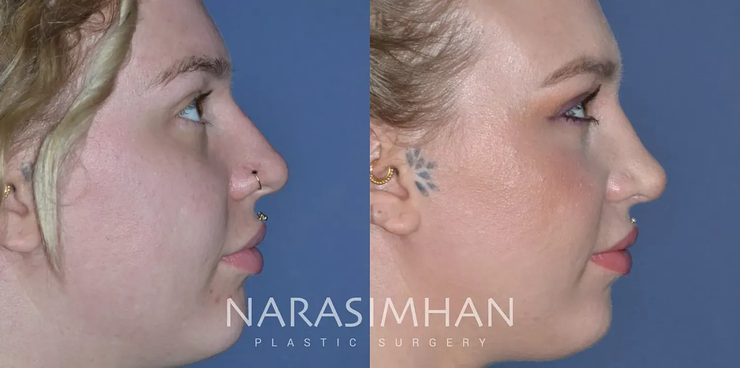 Facial Sculpting Before & After