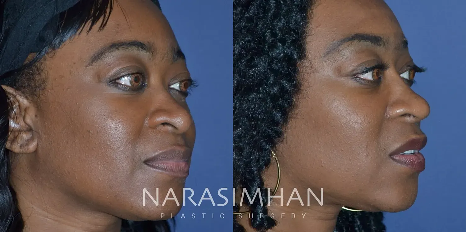 Facial Sculpting Before & After