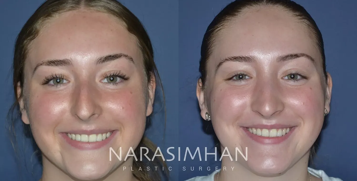 Facial Sculpting Before & After