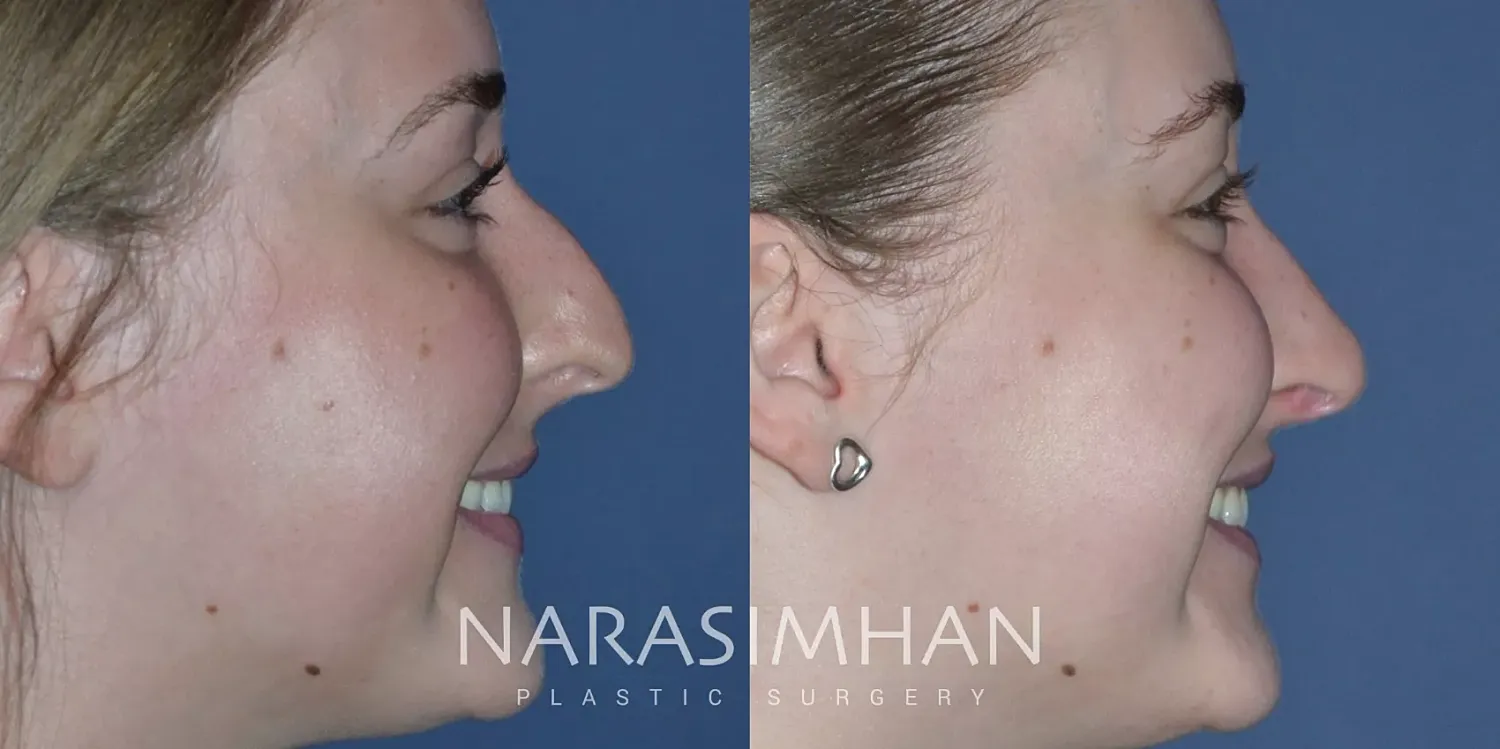 Facial Sculpting Before & After