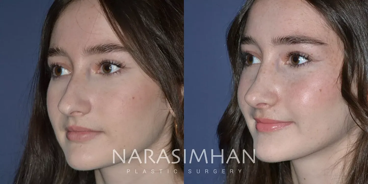 Facial Sculpting Before & After