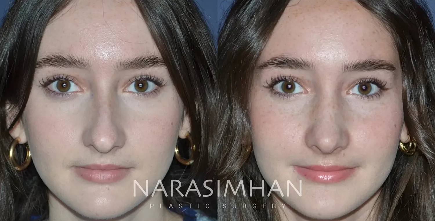Facial Sculpting Before & After
