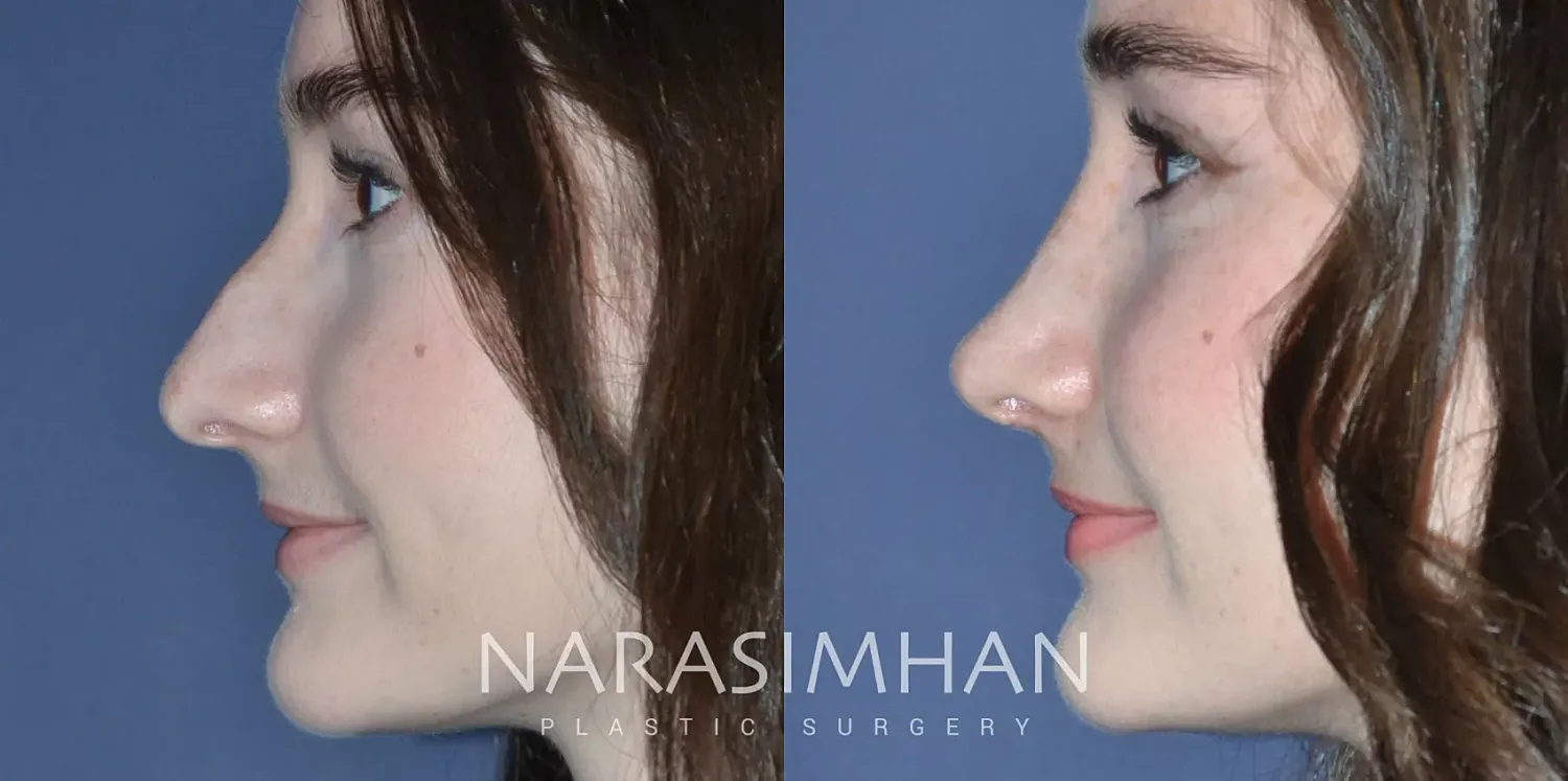 Facial Sculpting Before & After