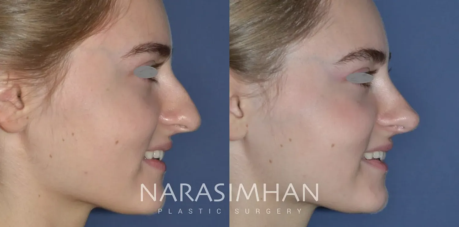 Facial Sculpting Before & After