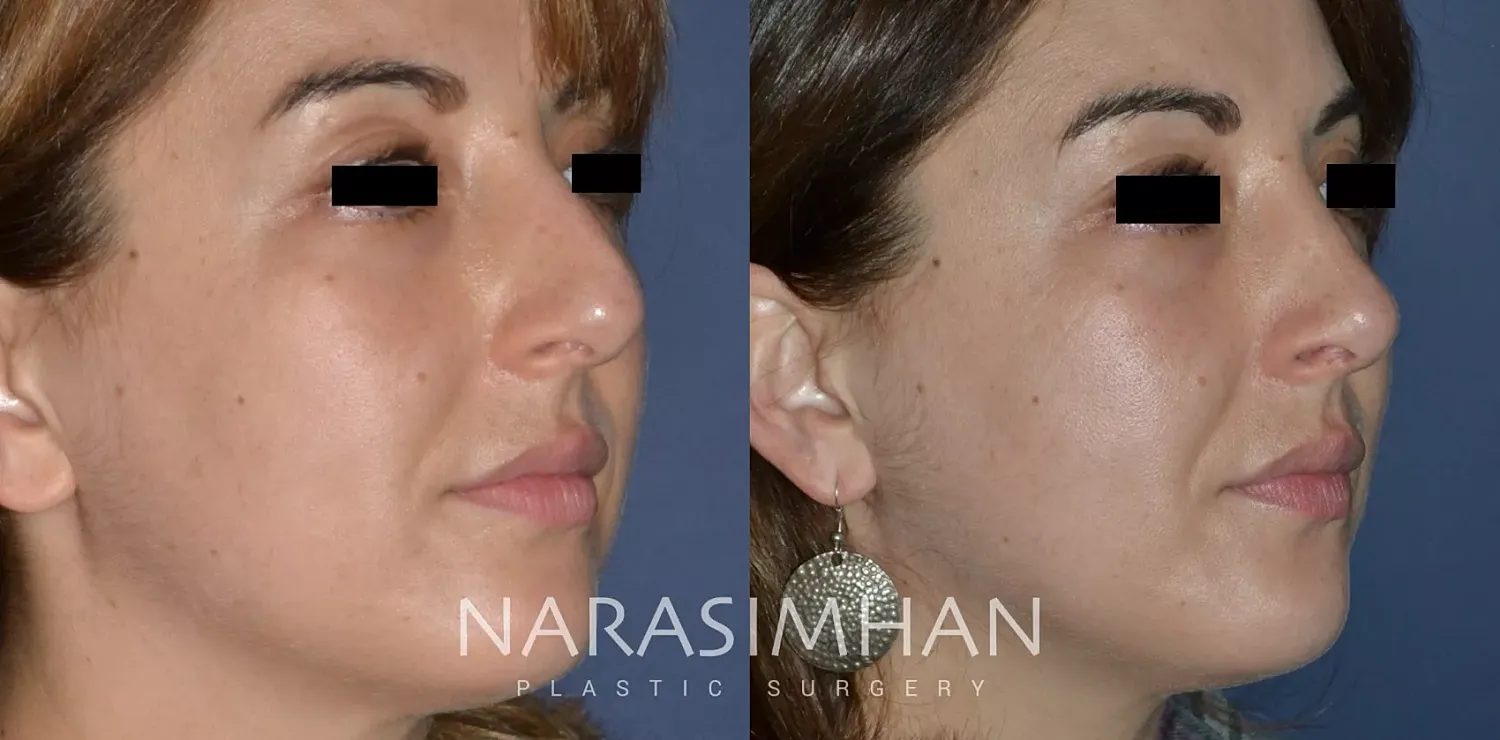 Facial Sculpting Before & After