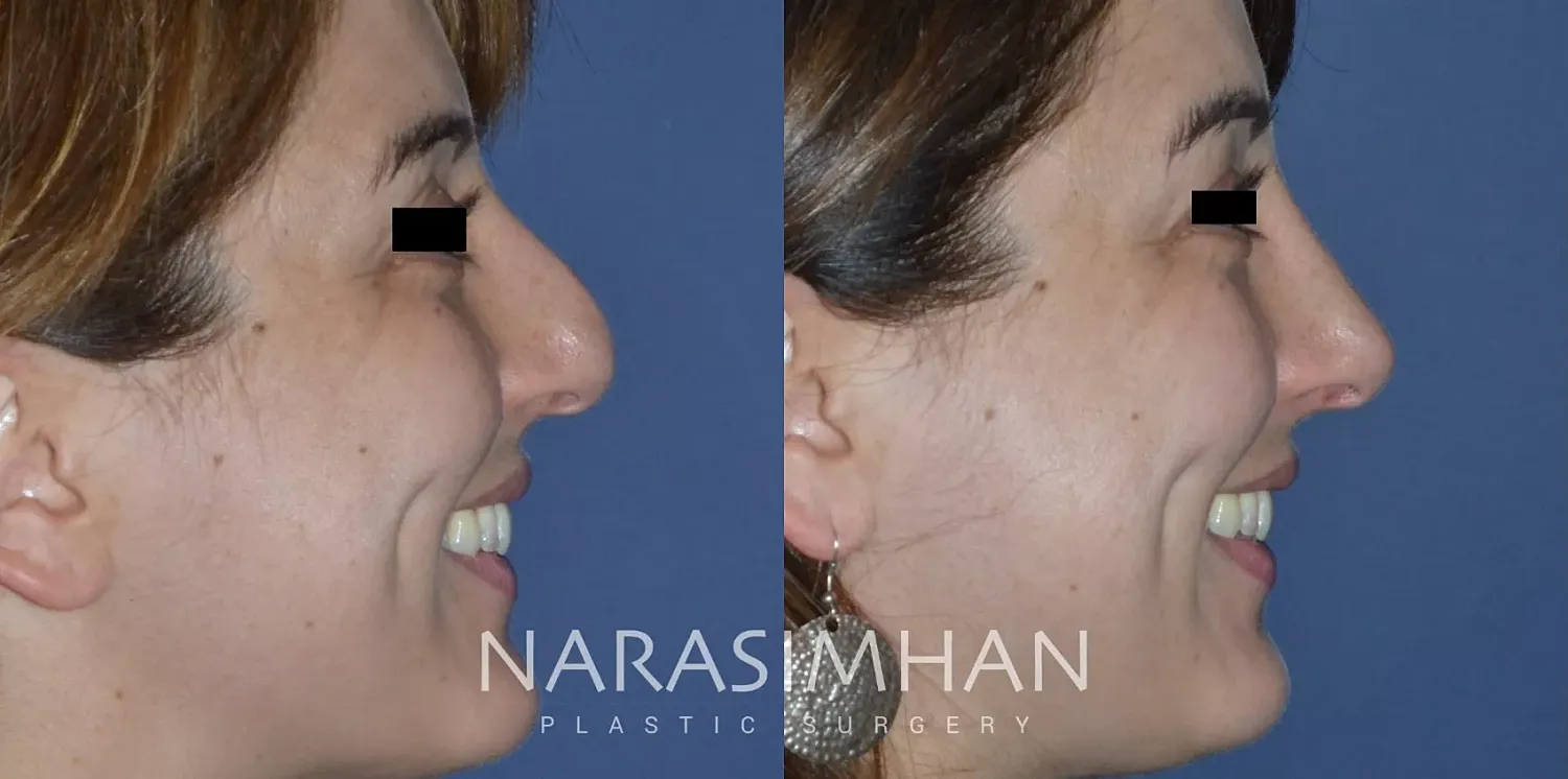 Facial Sculpting Before & After