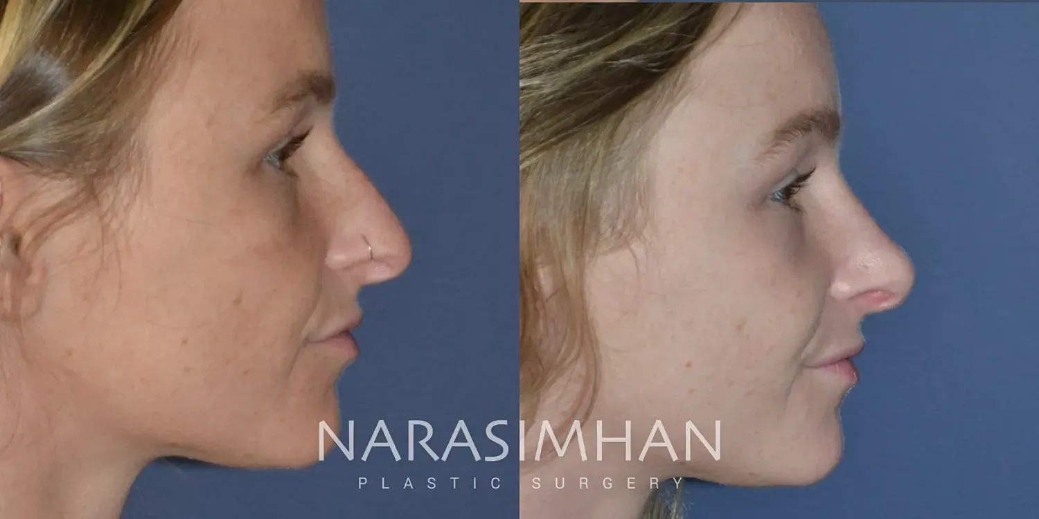 Facial Sculpting Before & After