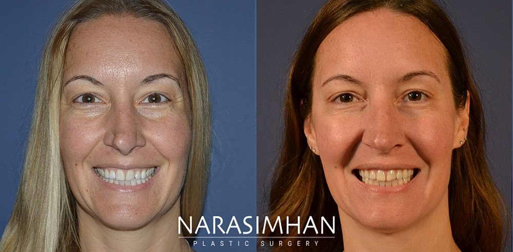 Facial Sculpting Before & After
