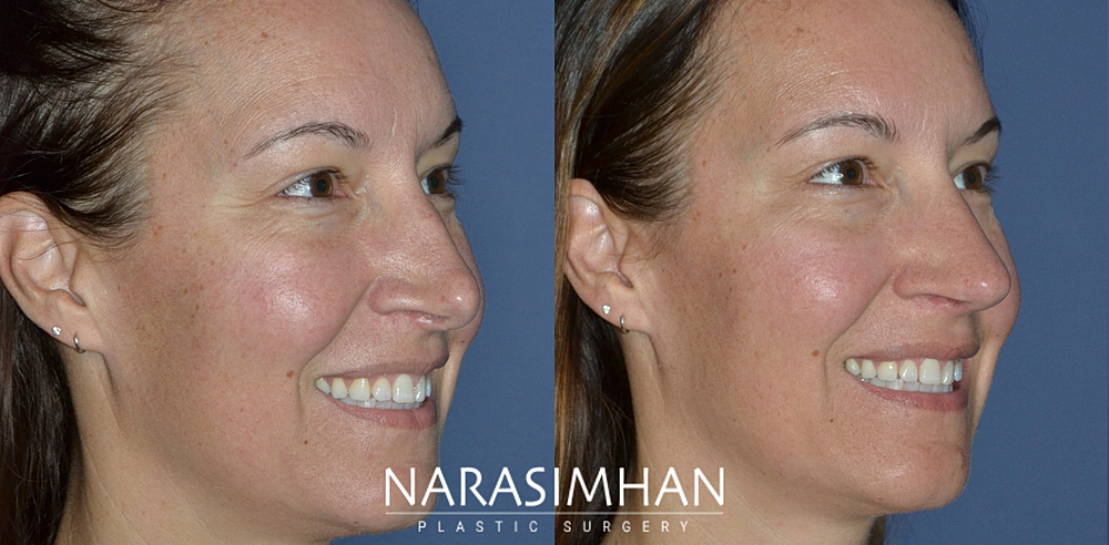 Facial Sculpting Before & After