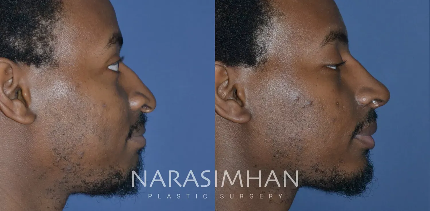 Facial Sculpting Before & After