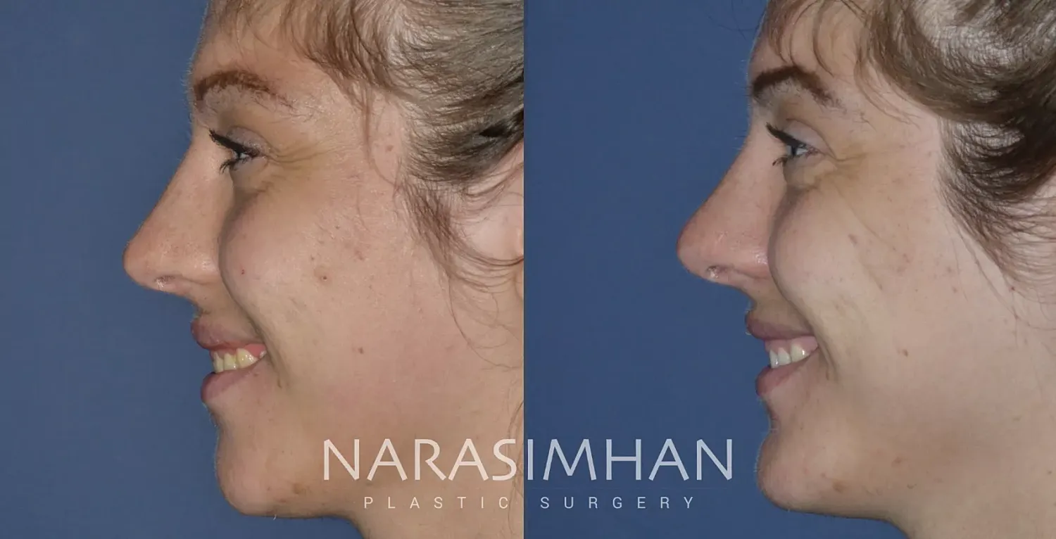 Facial Sculpting Before & After