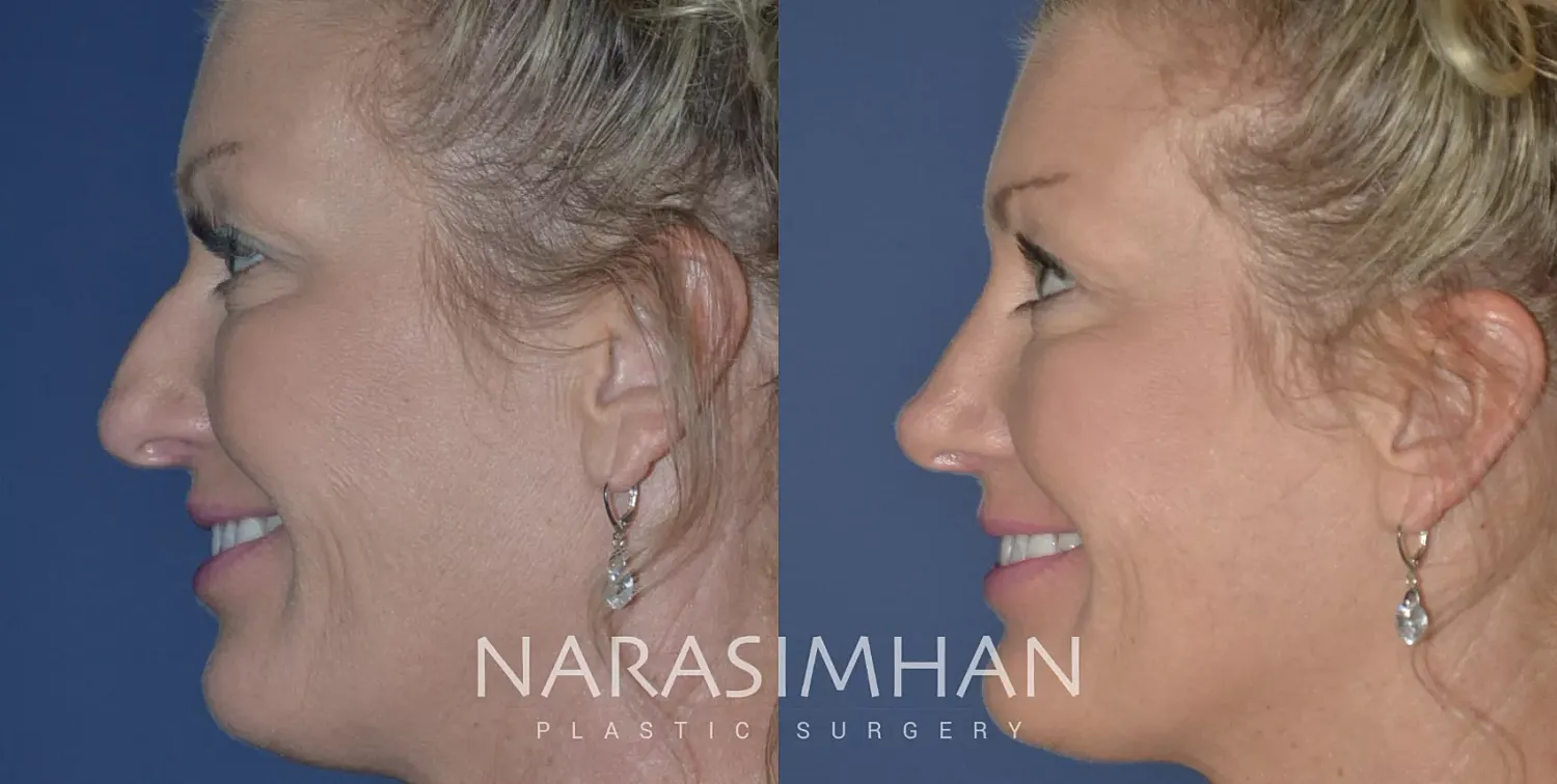 Facial Sculpting Before & After