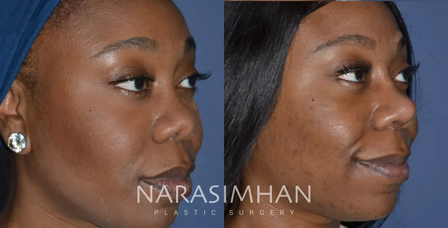 Facial Sculpting Before & After