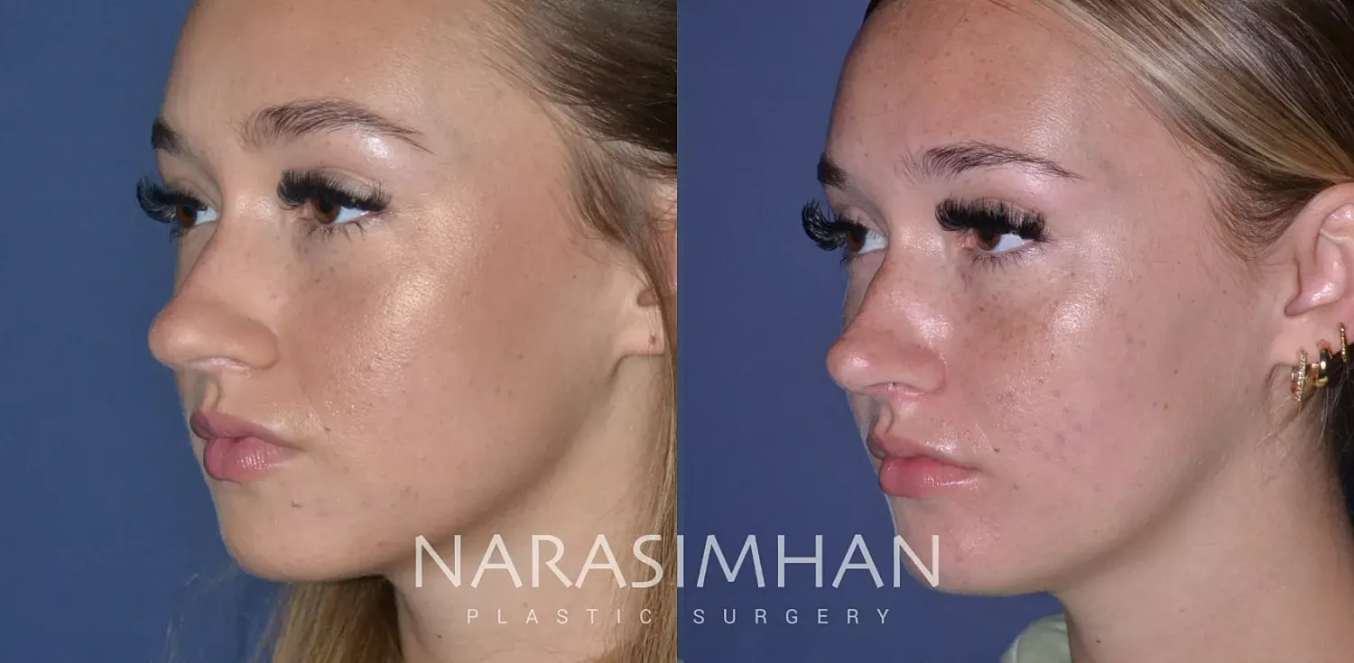 Facial Sculpting Before & After