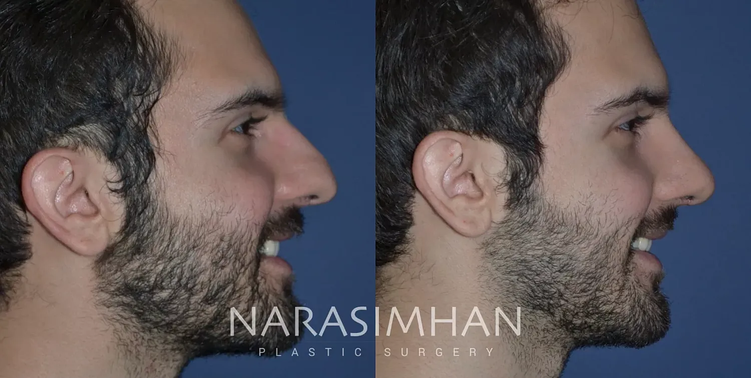 Facial Sculpting Before & After
