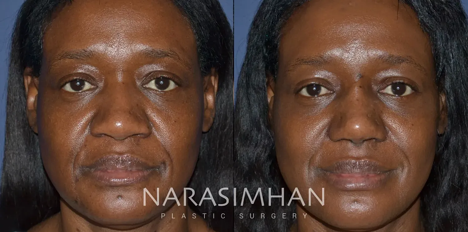 Facial Sculpting Before & After