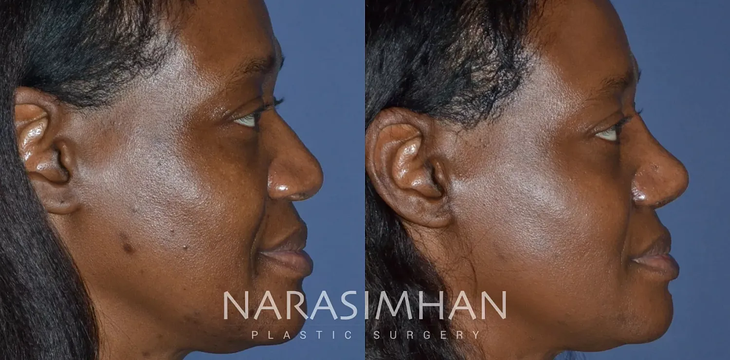 Facial Sculpting Before & After