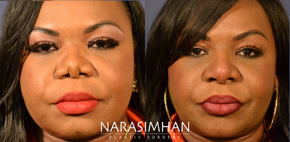 Facial Sculpting Before & After