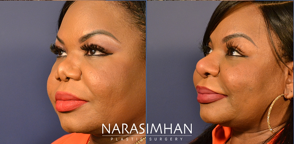 Facial Sculpting Before & After