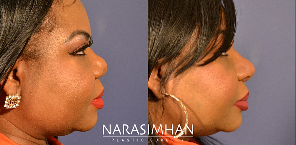 Facial Sculpting Before & After