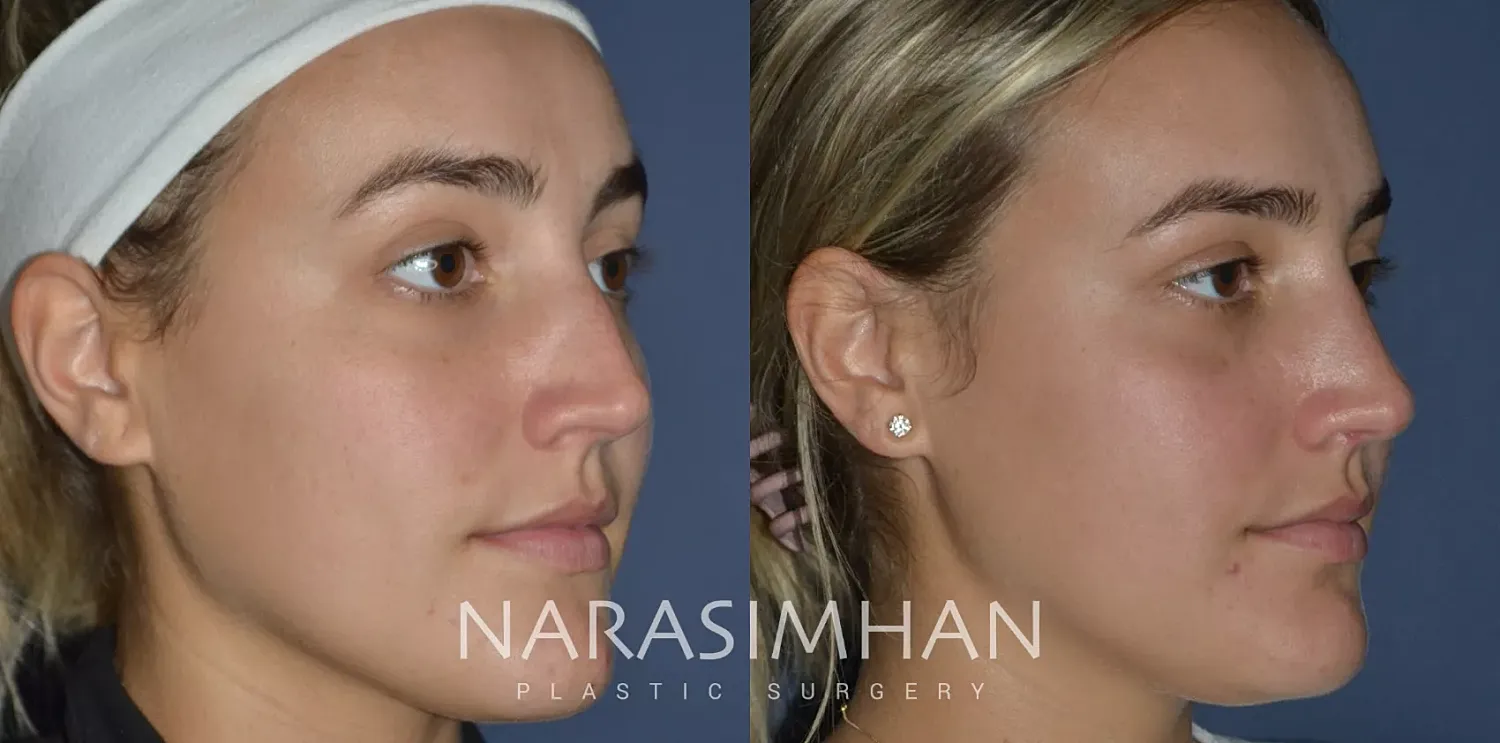 Facial Sculpting Before & After