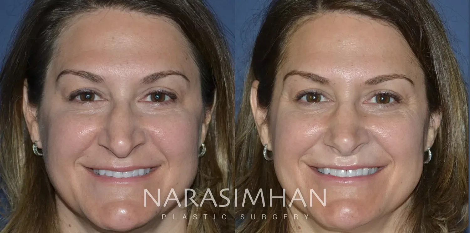 Facial Sculpting Before & After