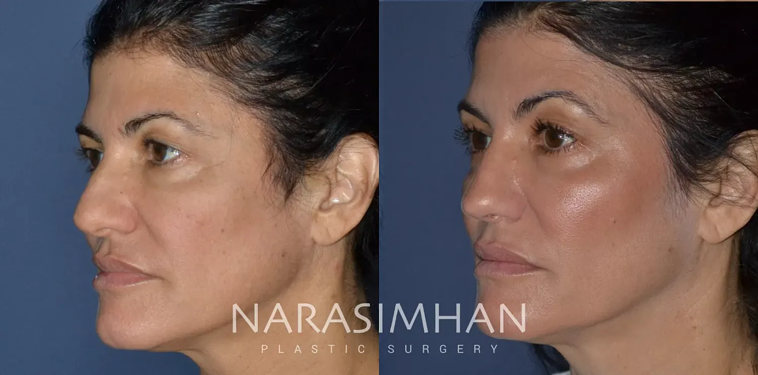 Facial Sculpting Before & After
