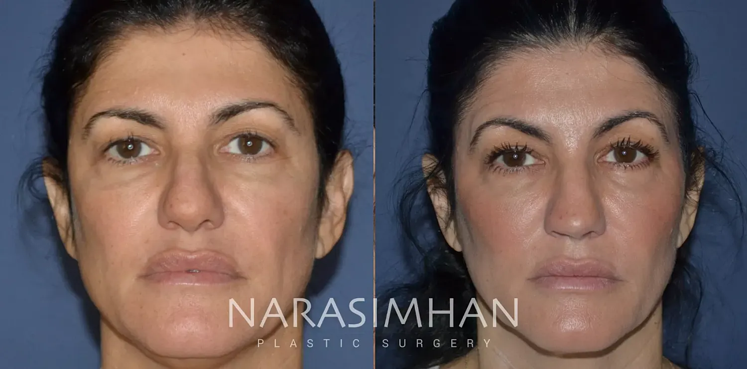 Facial Sculpting Before & After