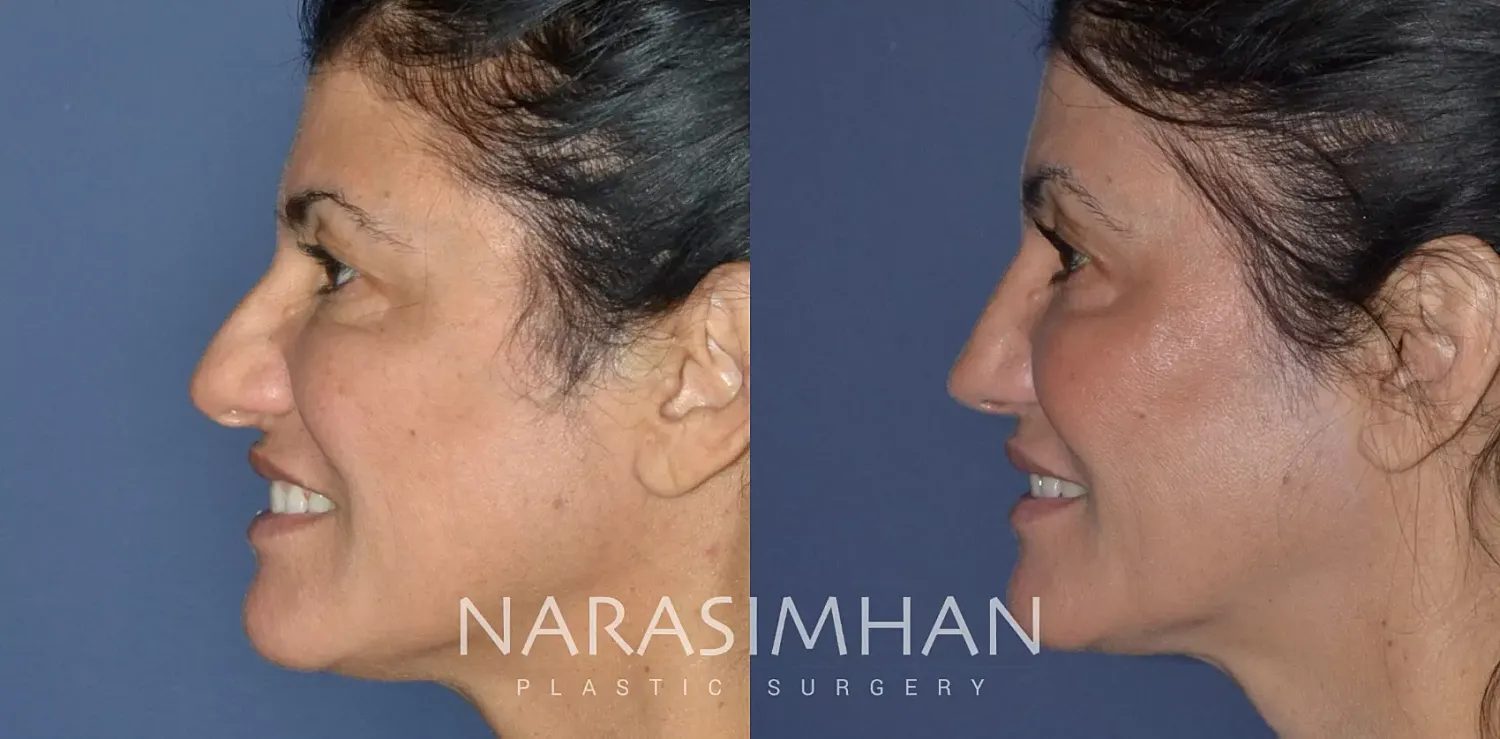 Facial Sculpting Before & After