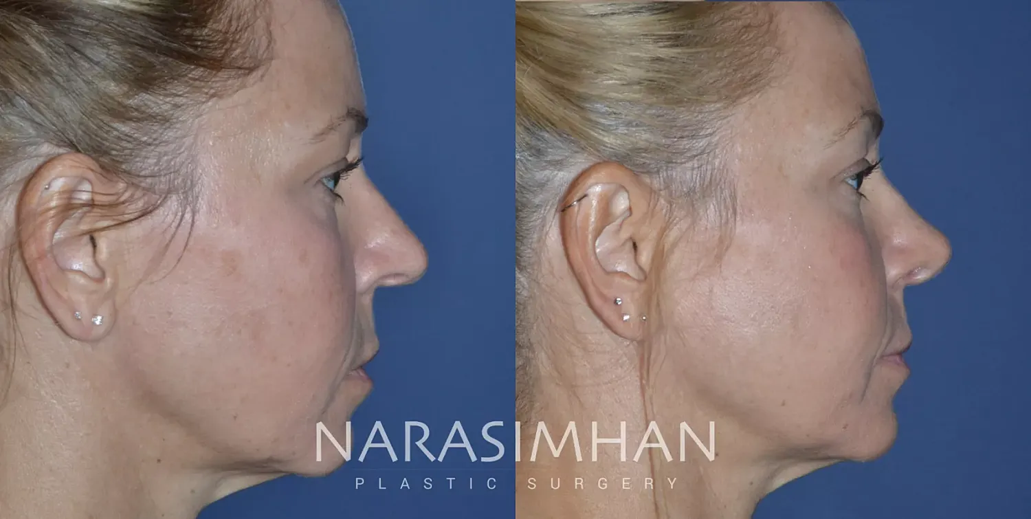Facial Sculpting Before & After