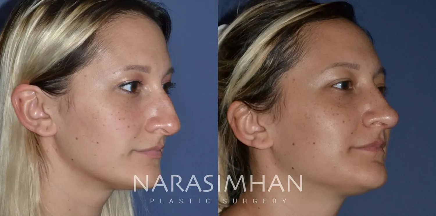 Facial Sculpting Before & After