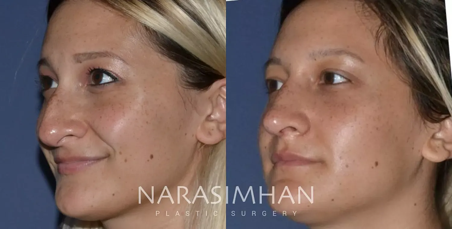 Facial Sculpting Before & After
