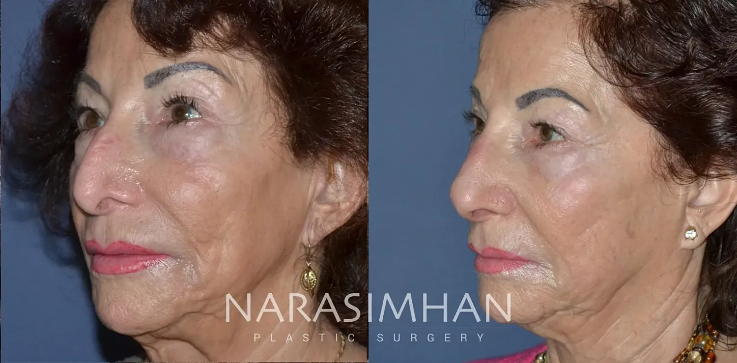 Facial Sculpting Before & After
