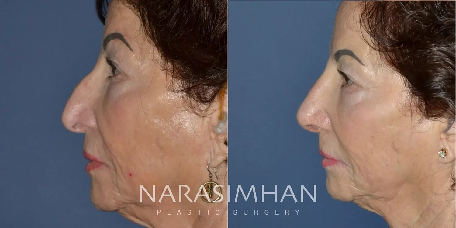 Facial Sculpting Before & After