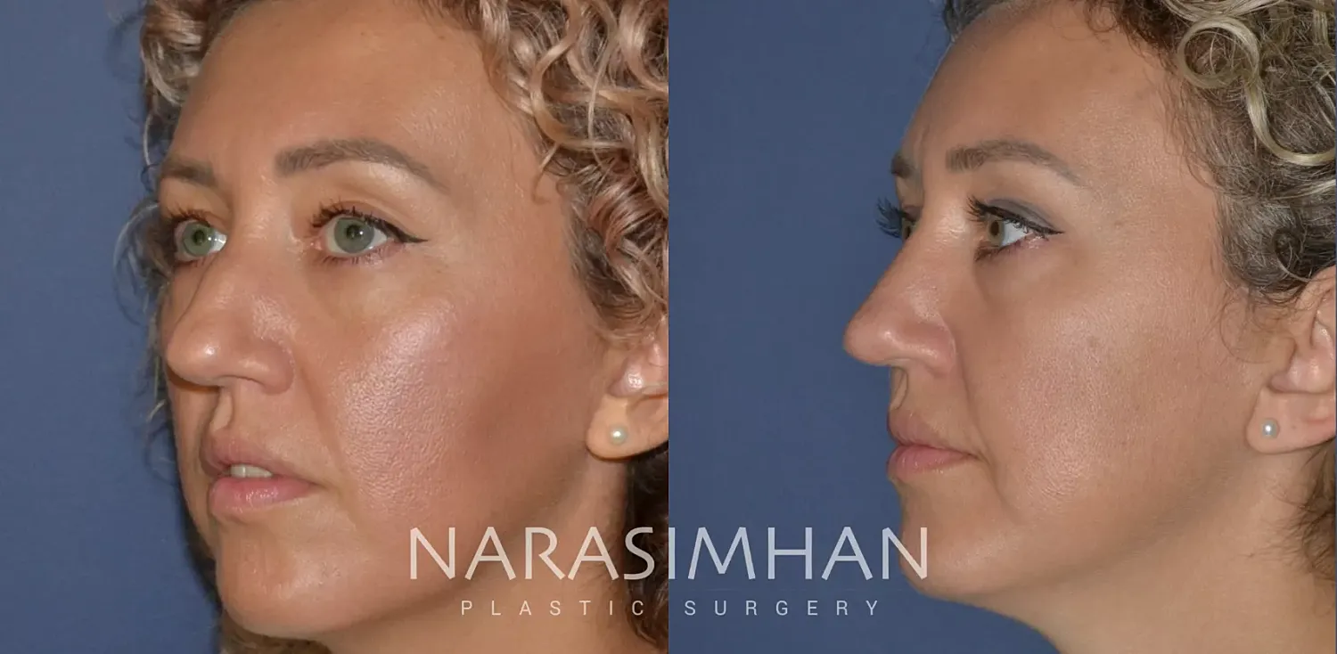 Facial Sculpting Before & After