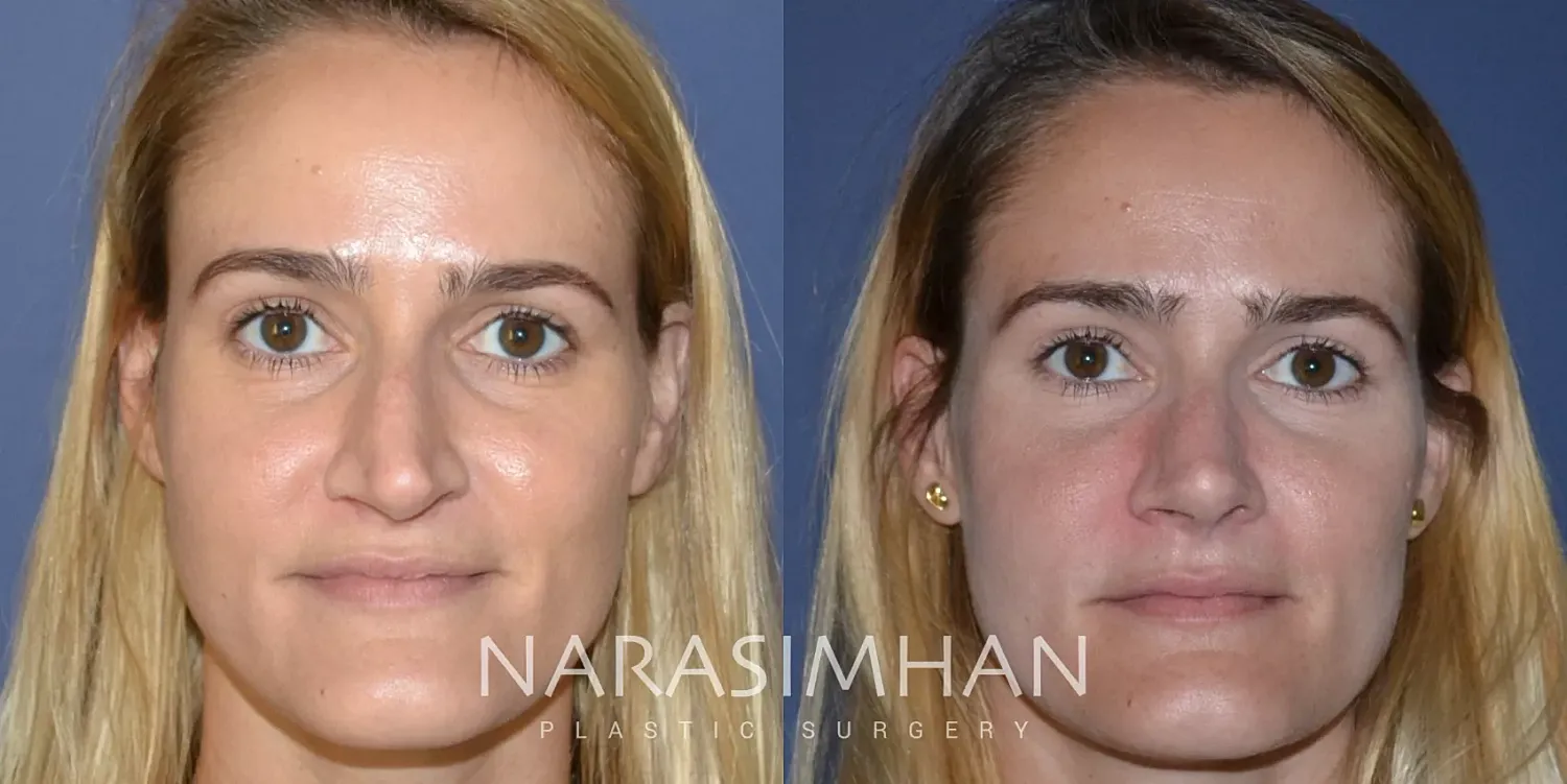 Facial Sculpting Before & After