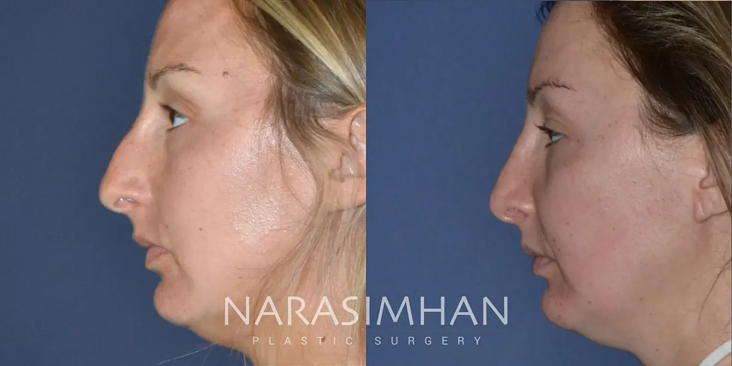 Facial Sculpting Before & After